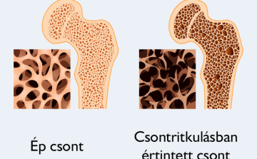 Csontritkulás szűrés az Egészségközpontban