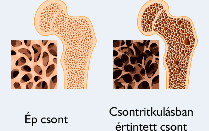 Csontritkulás szűrés az Egészségközpontban